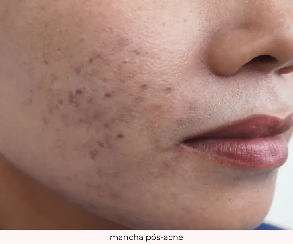 Rosto de uma mulher com várias manchas pós-acne na região da bochecha, destacando os efeitos de cicatrizes de acne.