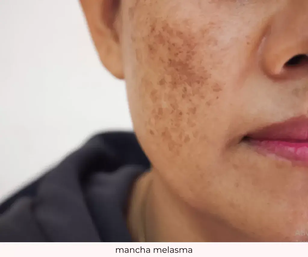 Rosto de uma mulher com manchas de melasma visíveis na bochecha, destacando áreas de hiperpigmentação.